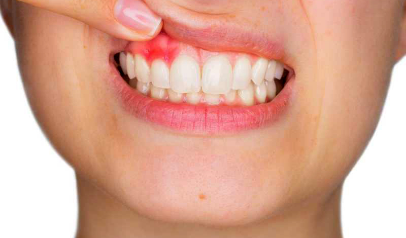 درد عصب کشی دندان