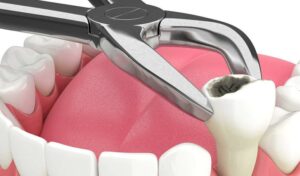 3 روش متفاوت بند آوردن خون ریزی دندان عقل