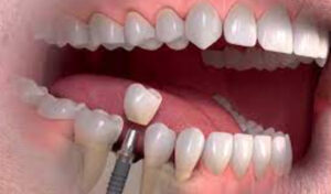 اجرای ایمپلنت بعد از کشیدن دندان