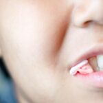 جلوگیری از خونریزی بعد از کشیدن دندان