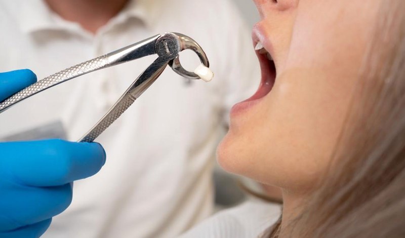 دندان عقل چه زمانی نیاز به جراحی دارد؟