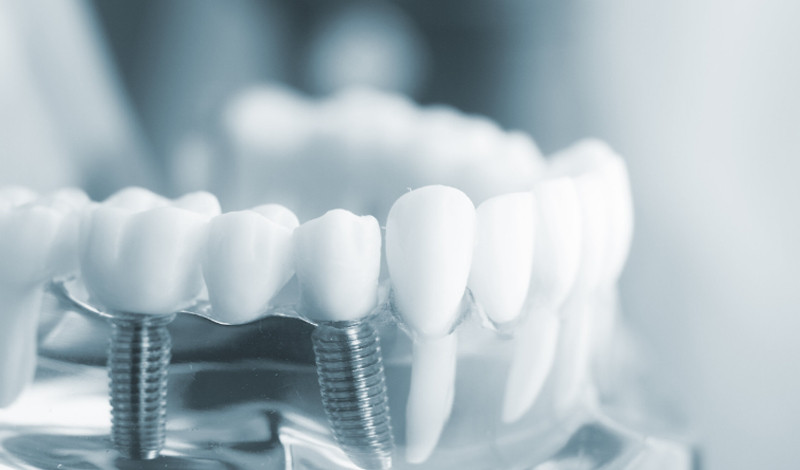 ایمپلنت دندان چند جلسه و چقدر طول میکشد؟