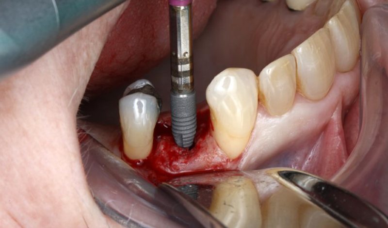 درصد موفقیت کاشت ایمپلنت دندان