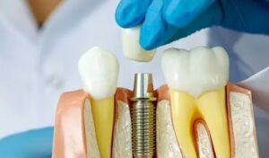 راه های مراقبت از ایمپلنت دندان