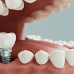 طول عمر ایمپلنت دندان چقدر است؟