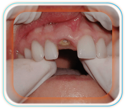 پاکسازی ریشه دندان برای ایمپلنت