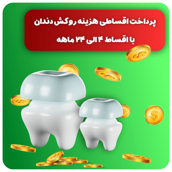 انواع روکش اقساطی مانند روکش طلا