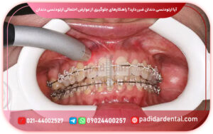 عوارض ارتودنسی دندان: آنچه باید قبل از درمان بدانید