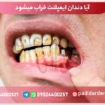 آیا دندان ایمپلنت خراب میشود؟