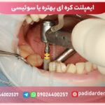 ایمپلنت کره ای بهتره یا سوئیسی