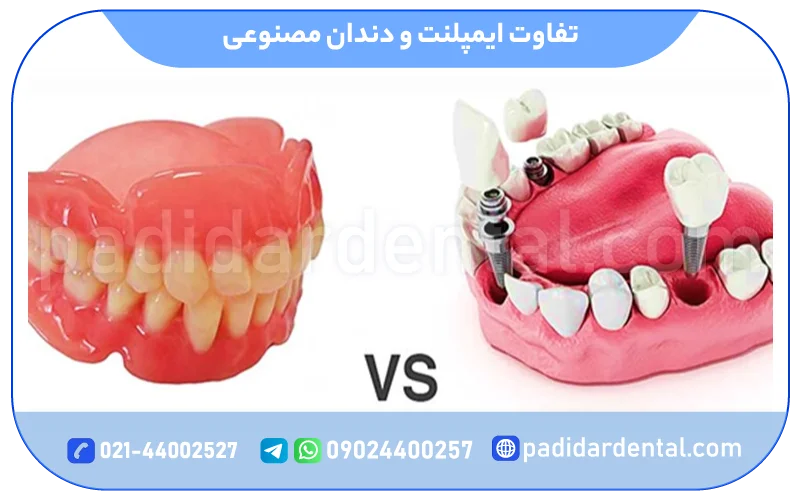 تفاوت ایمپلنت و دندان مصنوعی