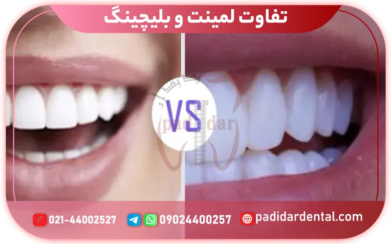 تفاوت لمینت و بلیچینگ