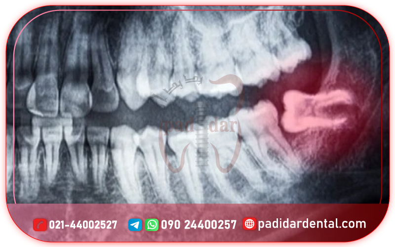 دندان عقل چه زمانی نیاز به جراحی دارد