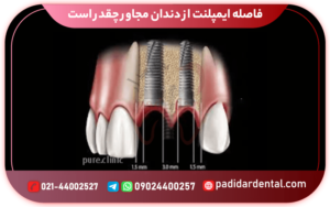 فاصله ایمپلنت از دندان مجاور چقدر است؟