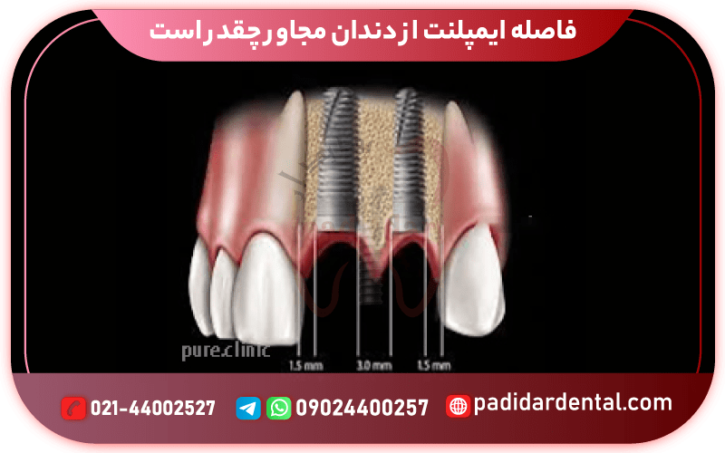 فاصله ایمپلنت از دندان مجاور چقدر است؟