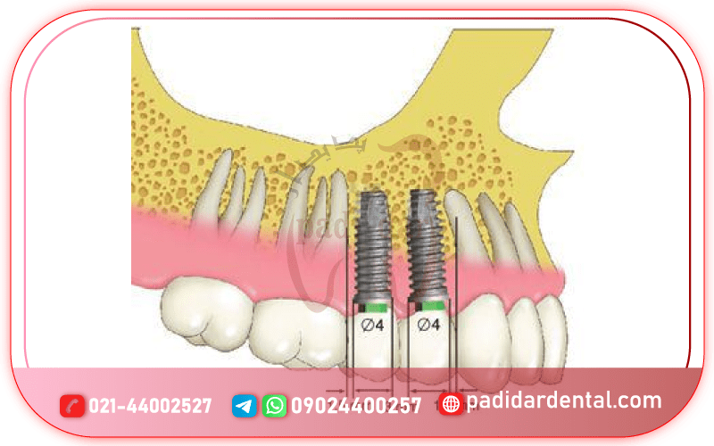 فاصله ایمپلنت از دندان مجاور چقدر است؟