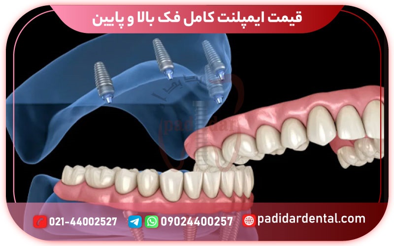 قیمت ایمپلنت کامل فک بالا و پایین