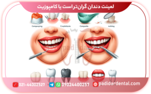 لمینت دندان گران‌تر است یا کامپوزیت ؟