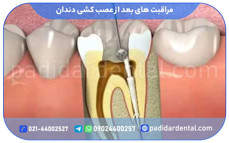 مراقبت های بعد از عصب کشی دندان