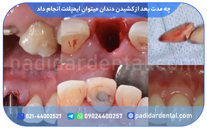 چه مدت بعد از کشیدن دندان میتوان ایمپلنت انجام داد؟