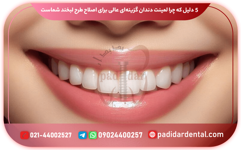 ۵ دلیل که چرا لمینت دندان گزینه‌ای عالی برای اصلاح طرح لبخند شماست