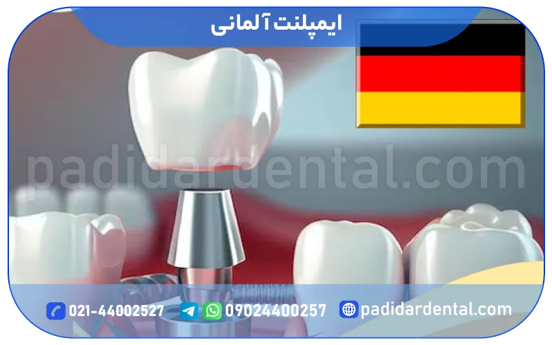 ایمپلنت آلمانی
