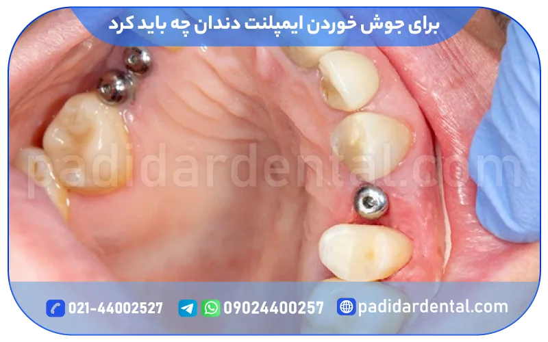 برای جوش خوردن ایمپلنت چیکار باید کرد