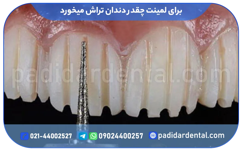 برای لمینت چقدر دندان تراش میخورد