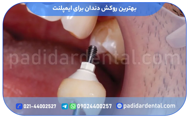 بهترین روکش دندان برای ایمپلنت