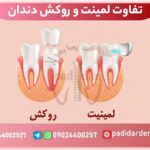 تفاوت لمینت و روکش دندان