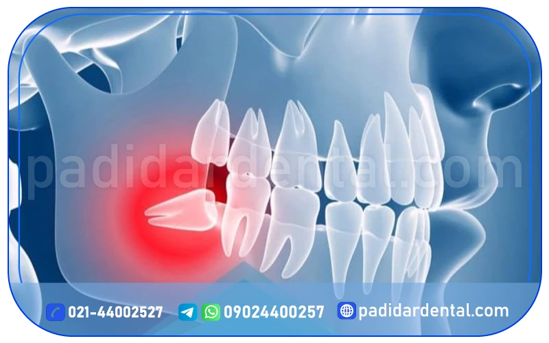 جراحی دندان عقل توسط جراح فک و صورت