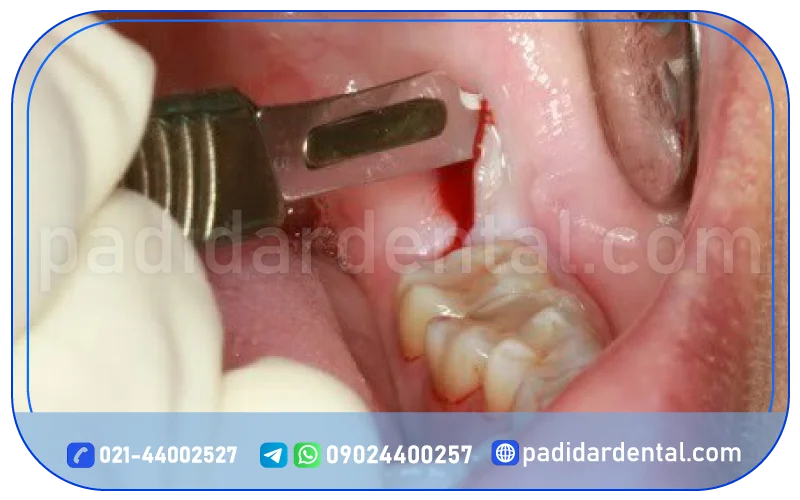 جراحی دندان عقل نهفته با لیزر