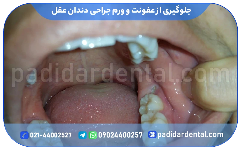 جلوگیری از عفونت و ورم جراحی دندان عقل