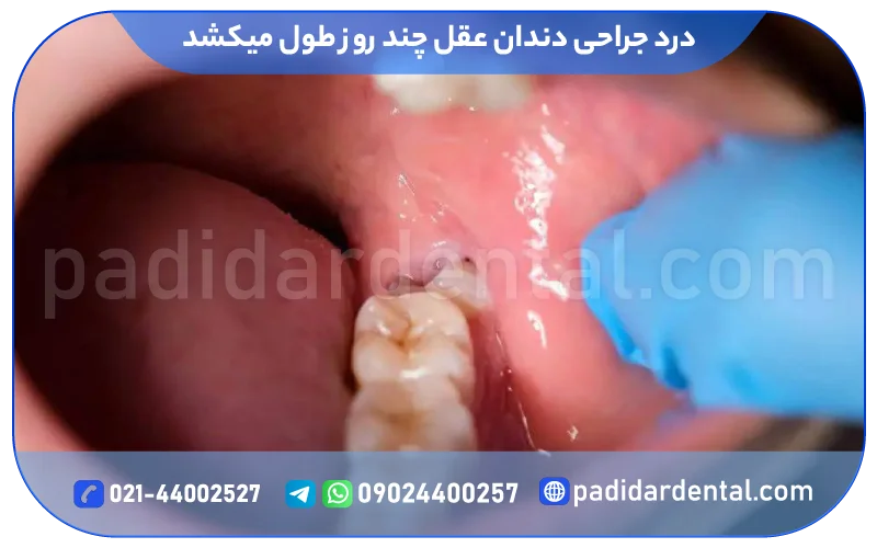 درد جراحی دندان عقل چند روز طول میکشد