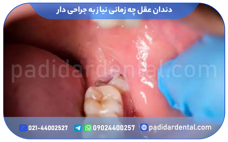 دندان عقل چه زمانی نیاز به جراحی دارد؟