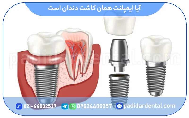 آیا ایمپلنت همان کاشت دندان است؟