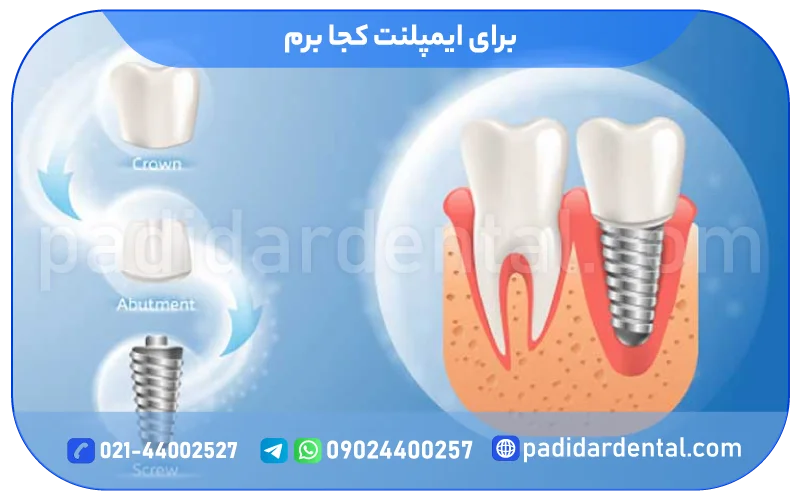برای کاشت ایمپلنت کجا برم؟