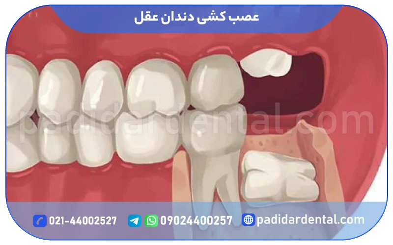 عصب کشی دندان عقل