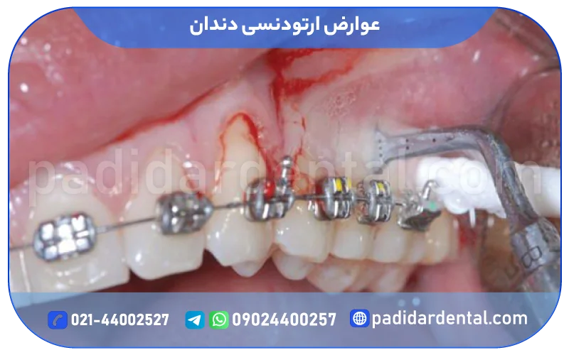 عوارض ارتودنسی دندان