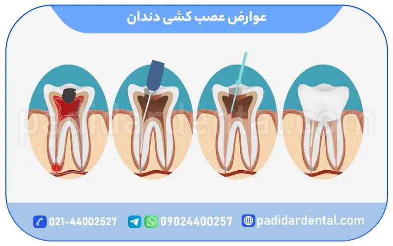 عوارض عصب کشی دندان