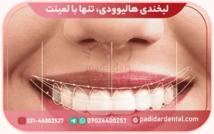 لبخندی هالیوودی، تنها با لمینت!