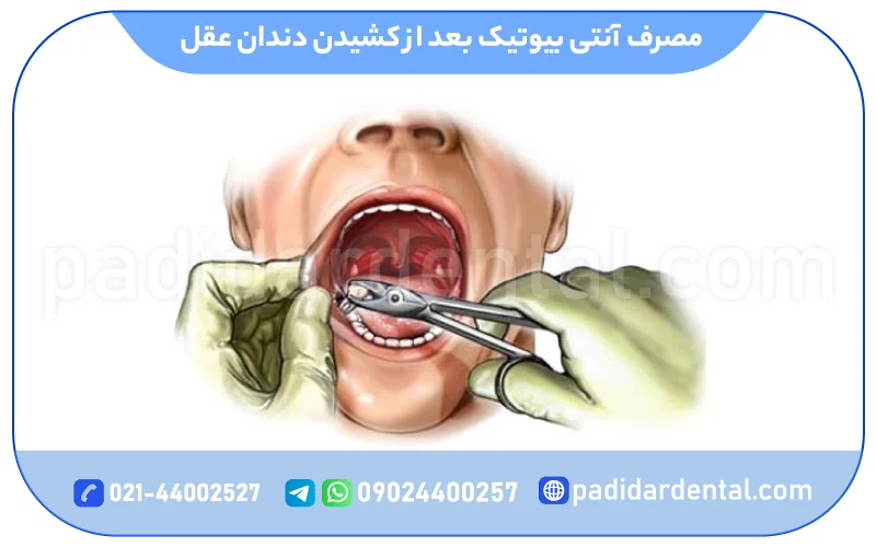 مصرف قرص بعد از کشیدن دندان عقل