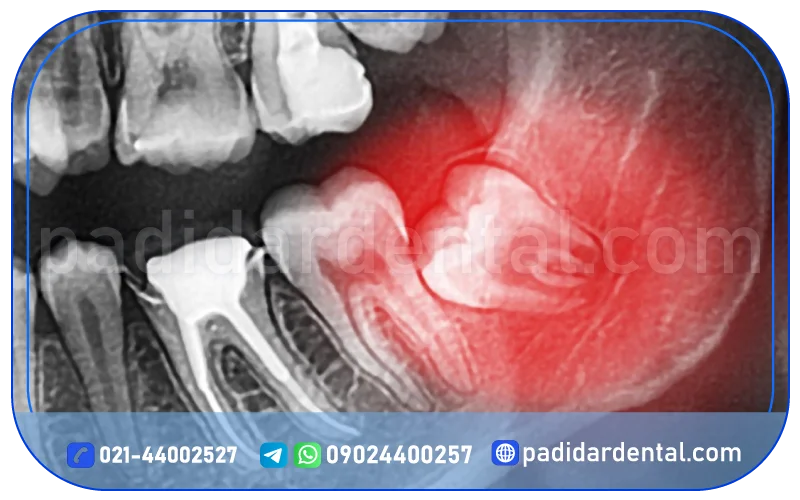 جراحی دندان عقل چگونه است؟