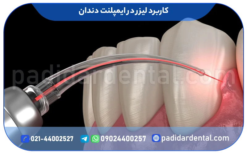 کاربرد لیزر در ایمپلنت دندان