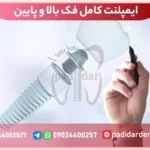 ایمپلنت کامل فک بالا و پایین