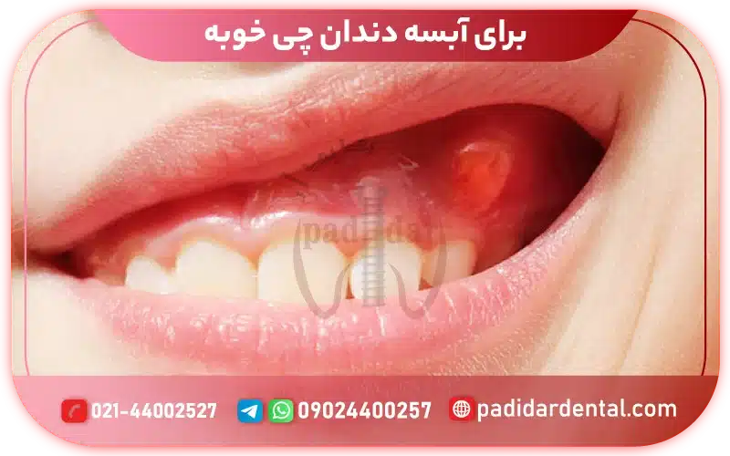 برای آبسه دندان چی خوبه؟