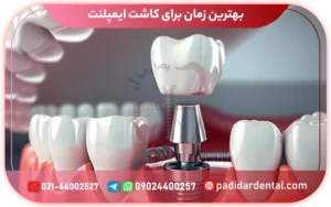 بهترین زمان برای کاشت ایمپلنت