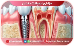 مزایای ایمپلنت دندان