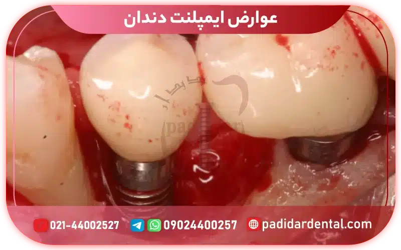 عوارض ایمپلنت دندان