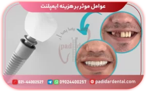 عوامل موثر بر هزینه ایمپلنت